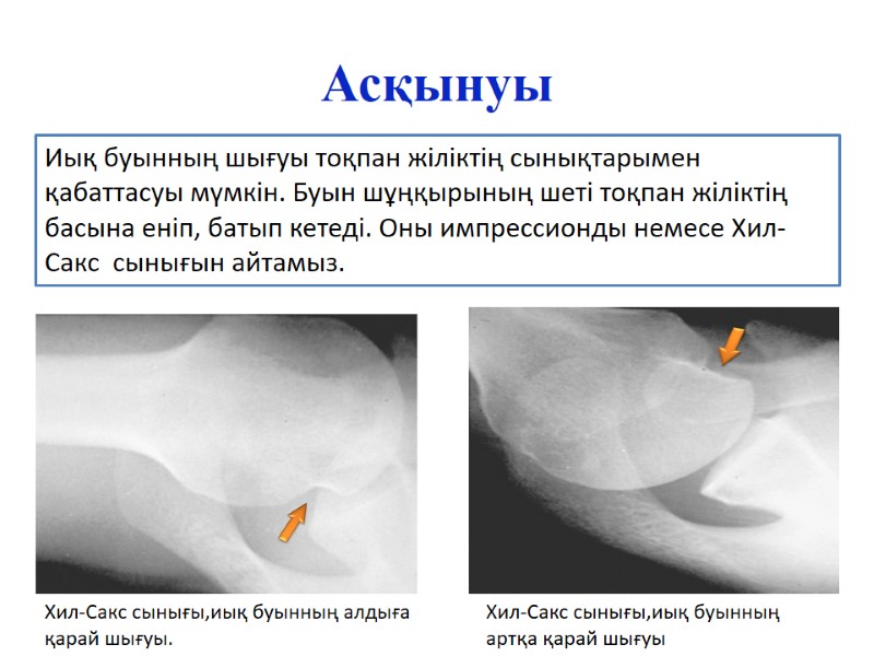 Асқынуы Хил-Сакс сынығы,иық буынның алдыға қарай шығуы. Хил-Сакс сынығы,иық буынның артқа қарай шығуы Иық